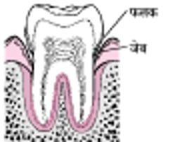 पेरियोडोंटाइटिस: प्लाक से दांत झड़ने तक