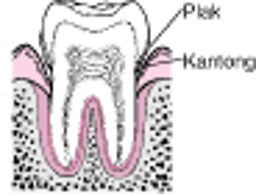 Periodontitis Dari Plak hingga Kehilangan Gigi