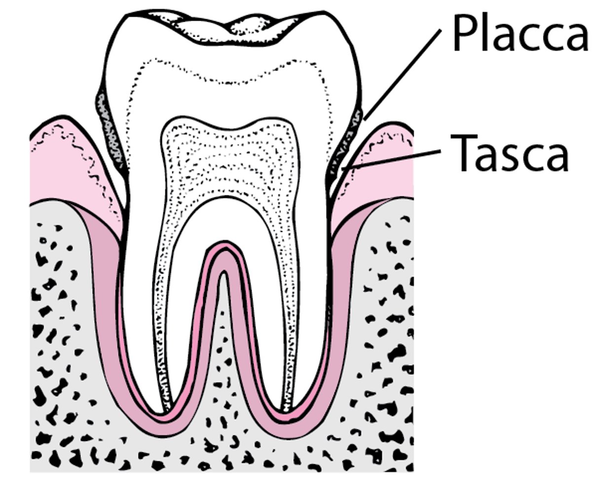 Parodontite: dalla placca alla perdita dei denti