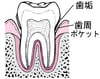 歯周炎：歯垢の蓄積から歯の喪失へ