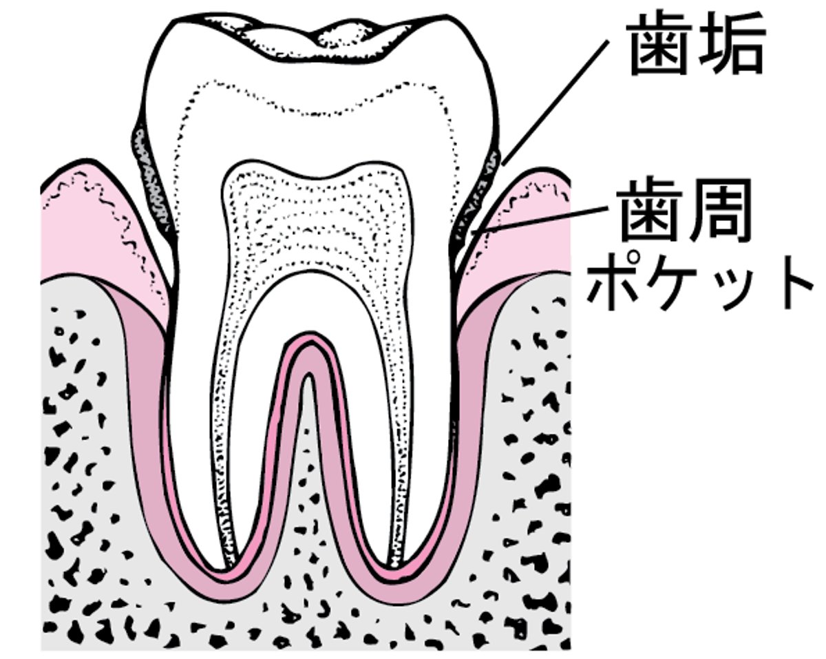 歯周炎：歯垢の蓄積から歯の喪失へ
