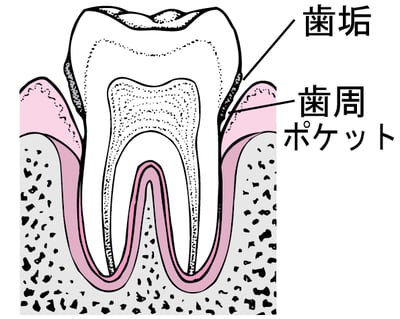 歯周炎：歯垢の蓄積から歯の喪失へ