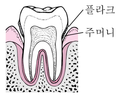 치주염: 플라크에서 치아 손실까지
