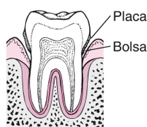 Periodontite: Da placa à perda do dente