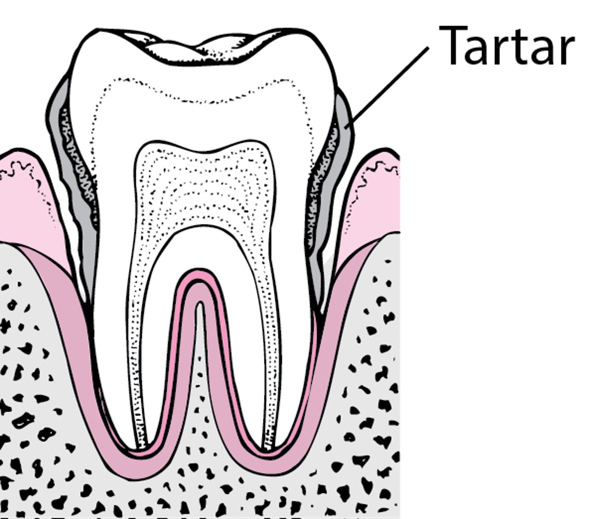 Periodontitis: From Plaque to Tooth Loss
