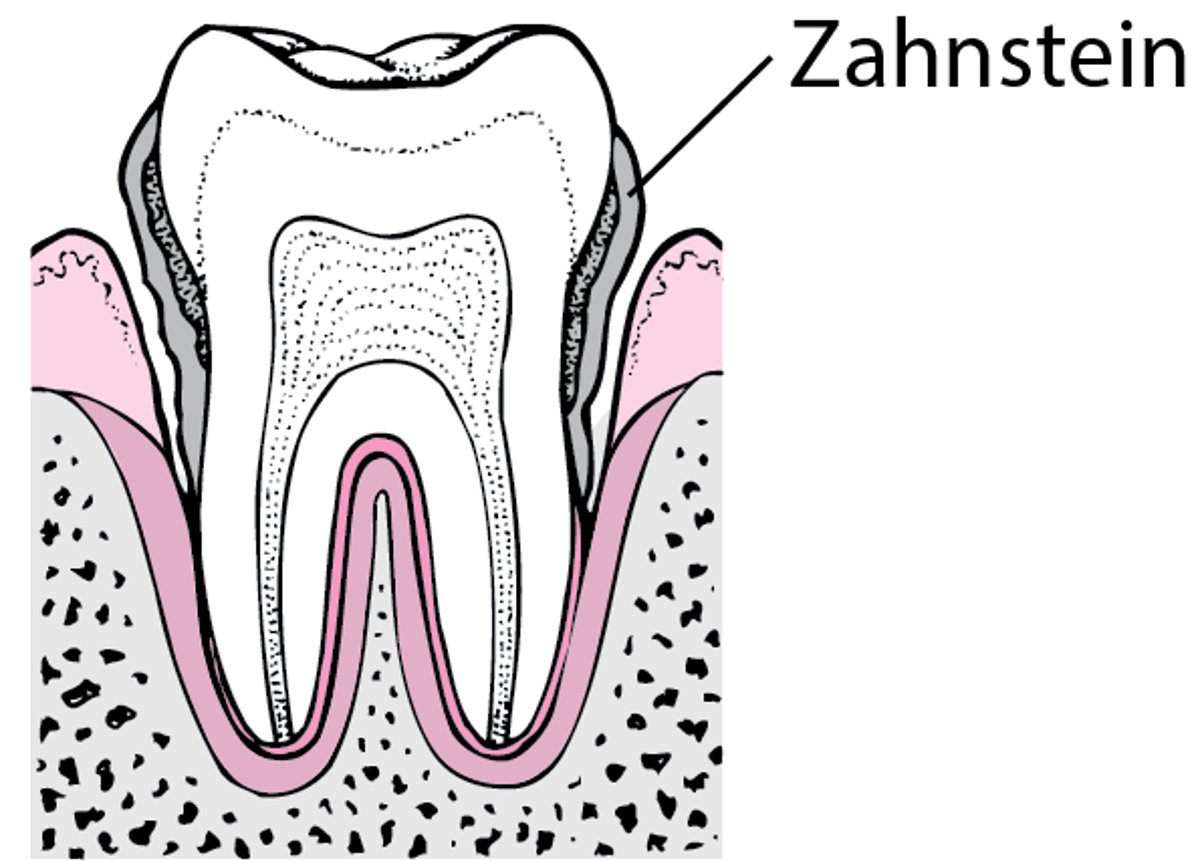 Parodontitis: Von Zahnbelägen zum Zahnverlust