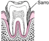 Periodontitis: de la formación de placa a la pérdida del diente
