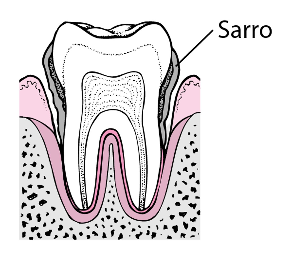 Periodontitis: de la formación de placa a la pérdida del diente