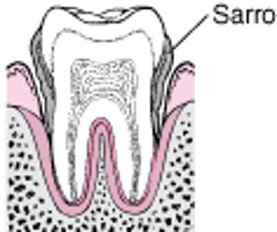 Periodontitis: de la formación de placa a la pérdida del diente