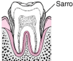 Periodontitis: de la formación de placa a la pérdida del diente