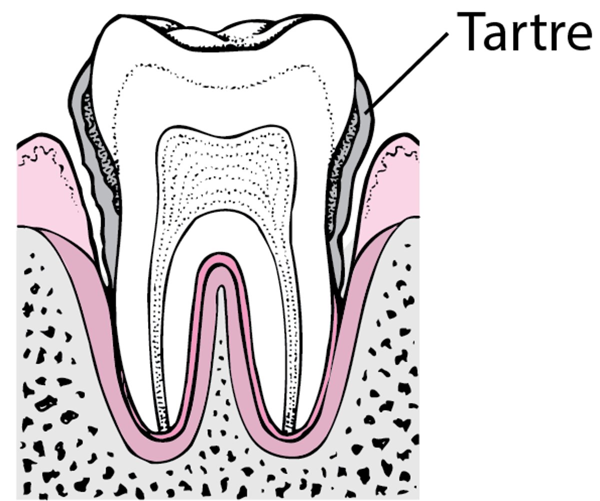 Parodontite : De la plaque à la perte dentaire