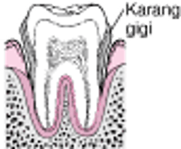 Periodontitis Dari Plak hingga Kehilangan Gigi