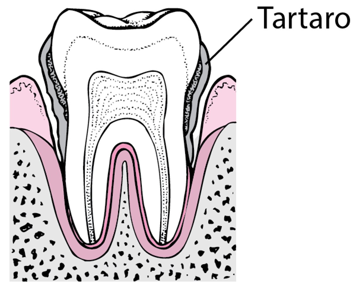 Parodontite: dalla placca alla perdita dei denti