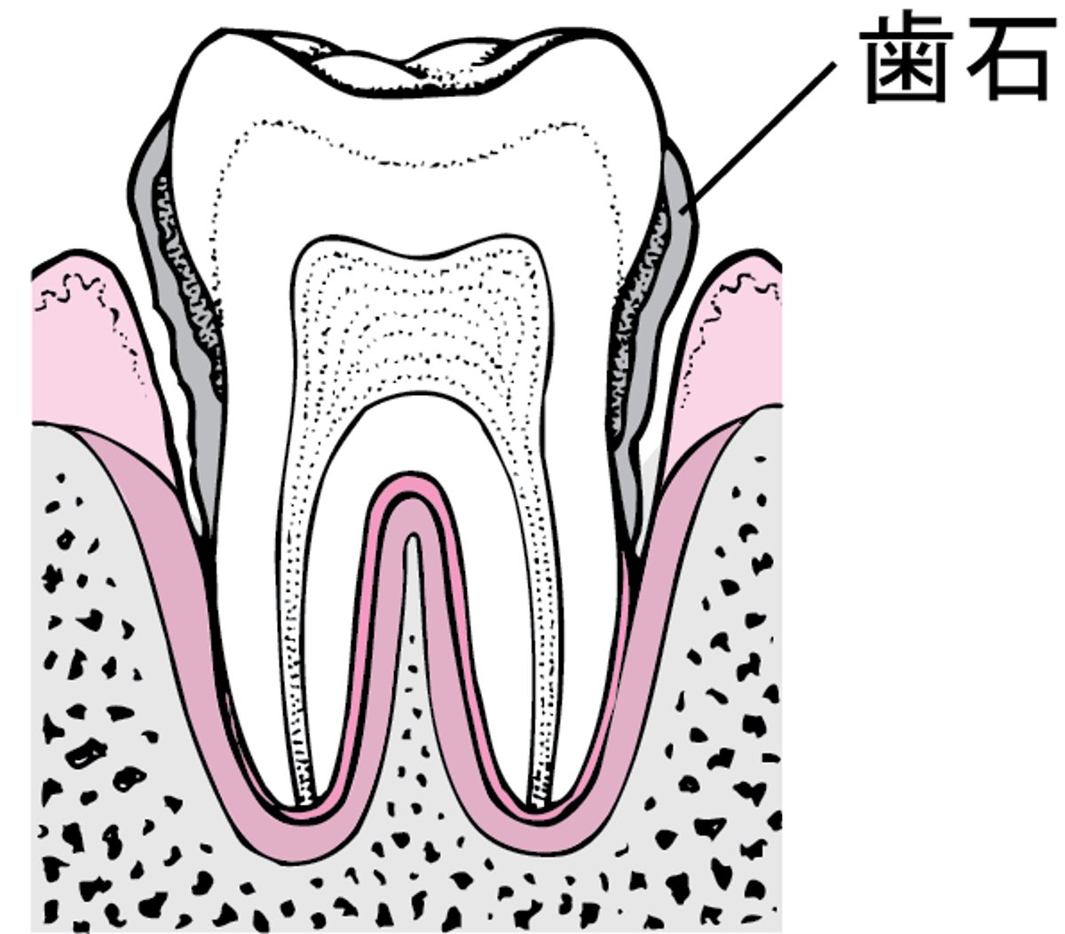 歯周炎：歯垢の蓄積から歯の喪失へ