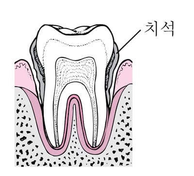 치주염: 플라크에서 치아 손실까지