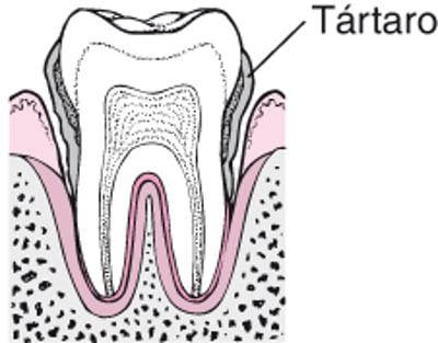 Periodontite: Da placa à perda do dente