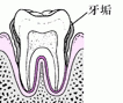 牙周炎：从菌斑堆积到牙齿松动的过程