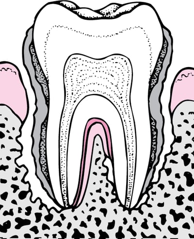 Periodontitis: From Plaque to Tooth Loss