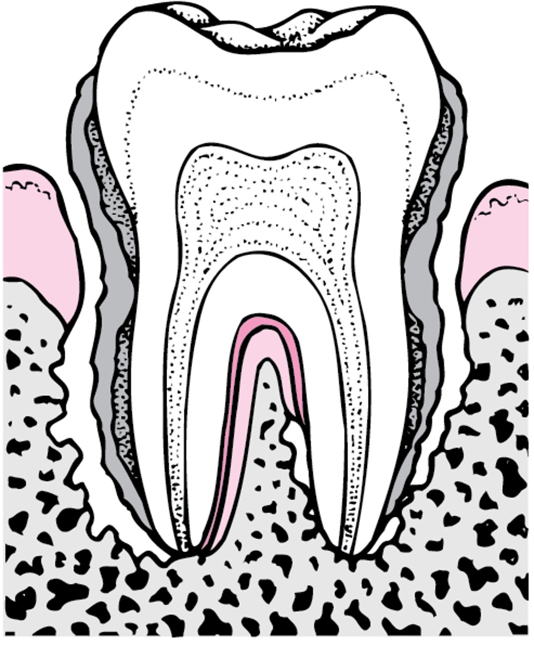 Parodontitis: Von Zahnbelägen zum Zahnverlust