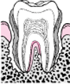 Periodontitis: de la formación de placa a la pérdida del diente