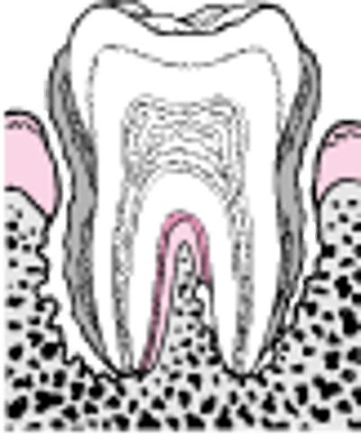 Periodontitis: de la formación de placa a la pérdida del diente