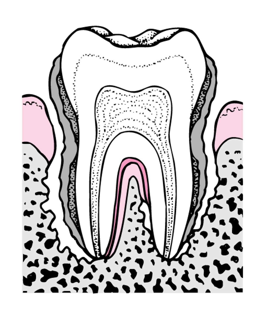 Periodontitis: de la formación de placa a la pérdida del diente