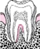 पेरियोडोंटाइटिस: प्लाक से दांत झड़ने तक