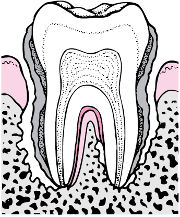 歯周炎：歯垢の蓄積から歯の喪失へ