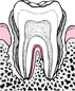 Periodontite: Da placa à perda do dente