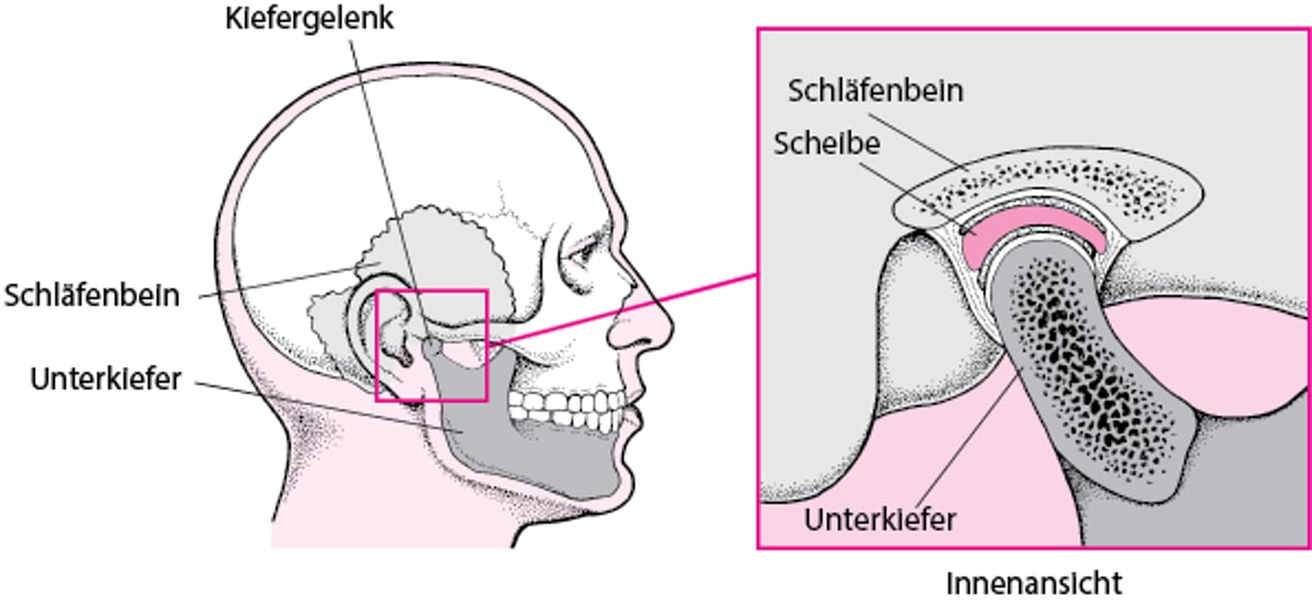 Kiefergelenkerkrankungen (CMD) Kiefergelenkerkrankungen (CMD) MSD Manual Ausgabe für Patienten