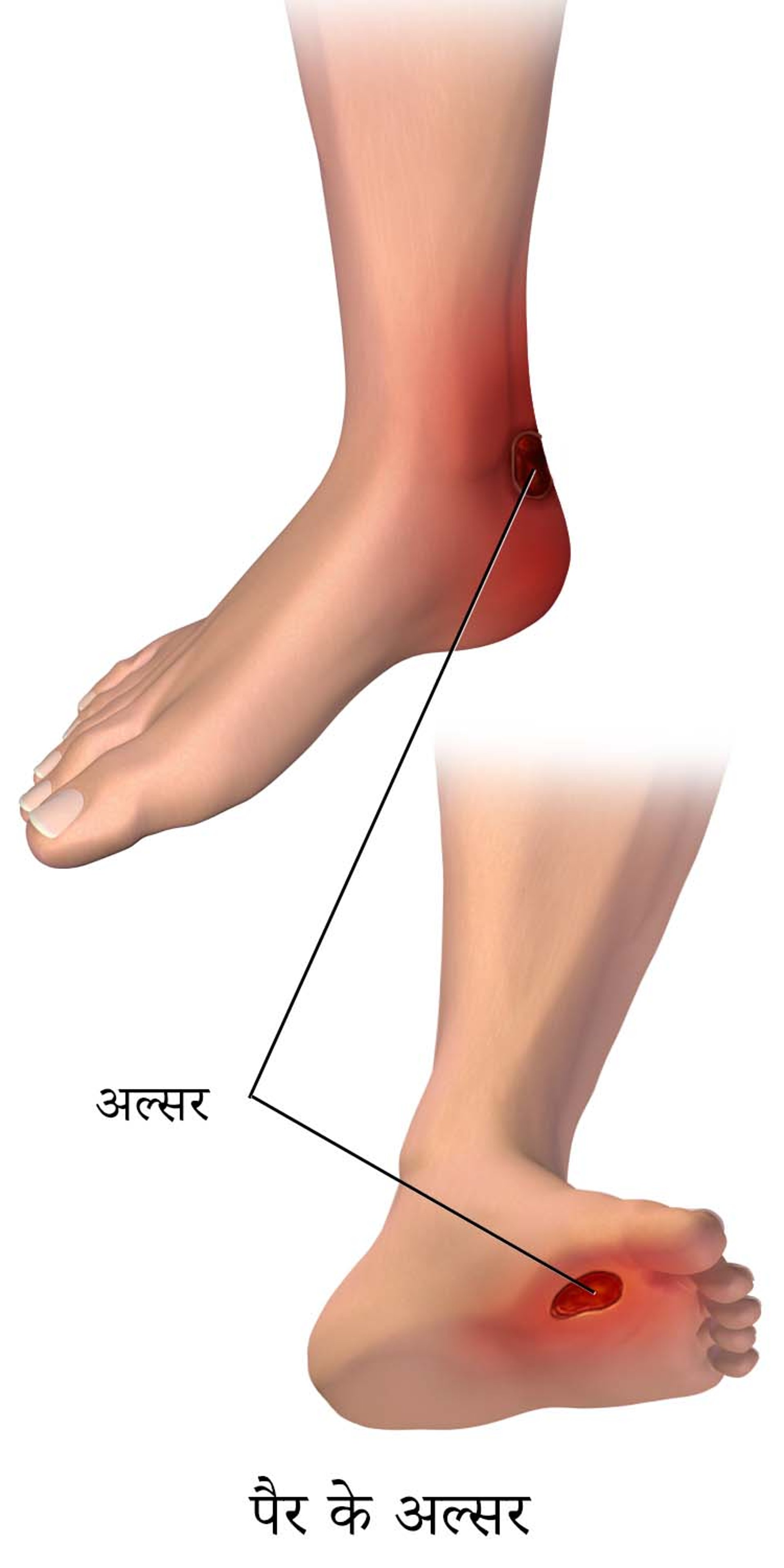 डायबिटीज से पैरों में होने वाले अल्सर