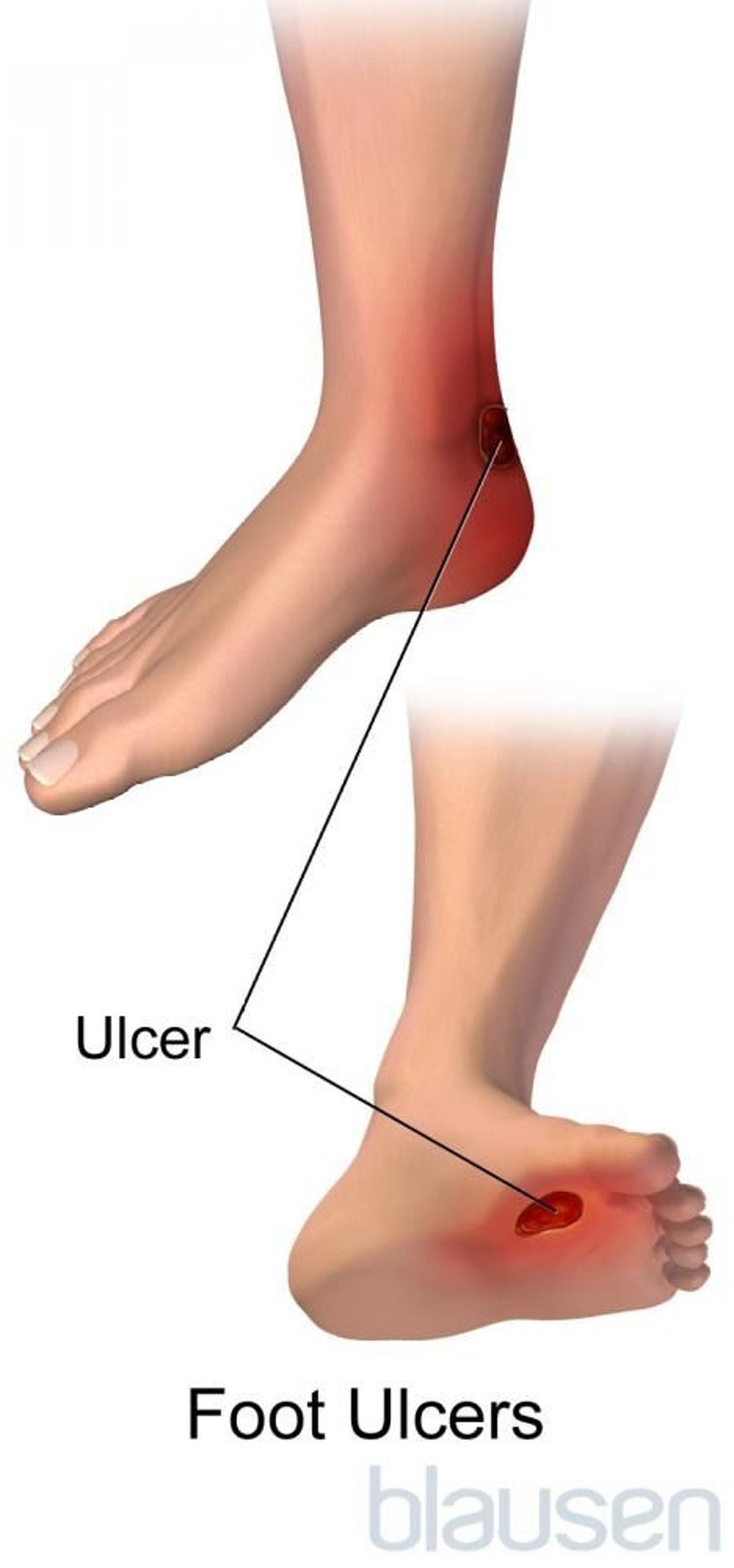 Úlceras nos pés resultantes do diabetes