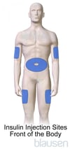 Diabetes Insulin Injection Sites (Front of the Body)