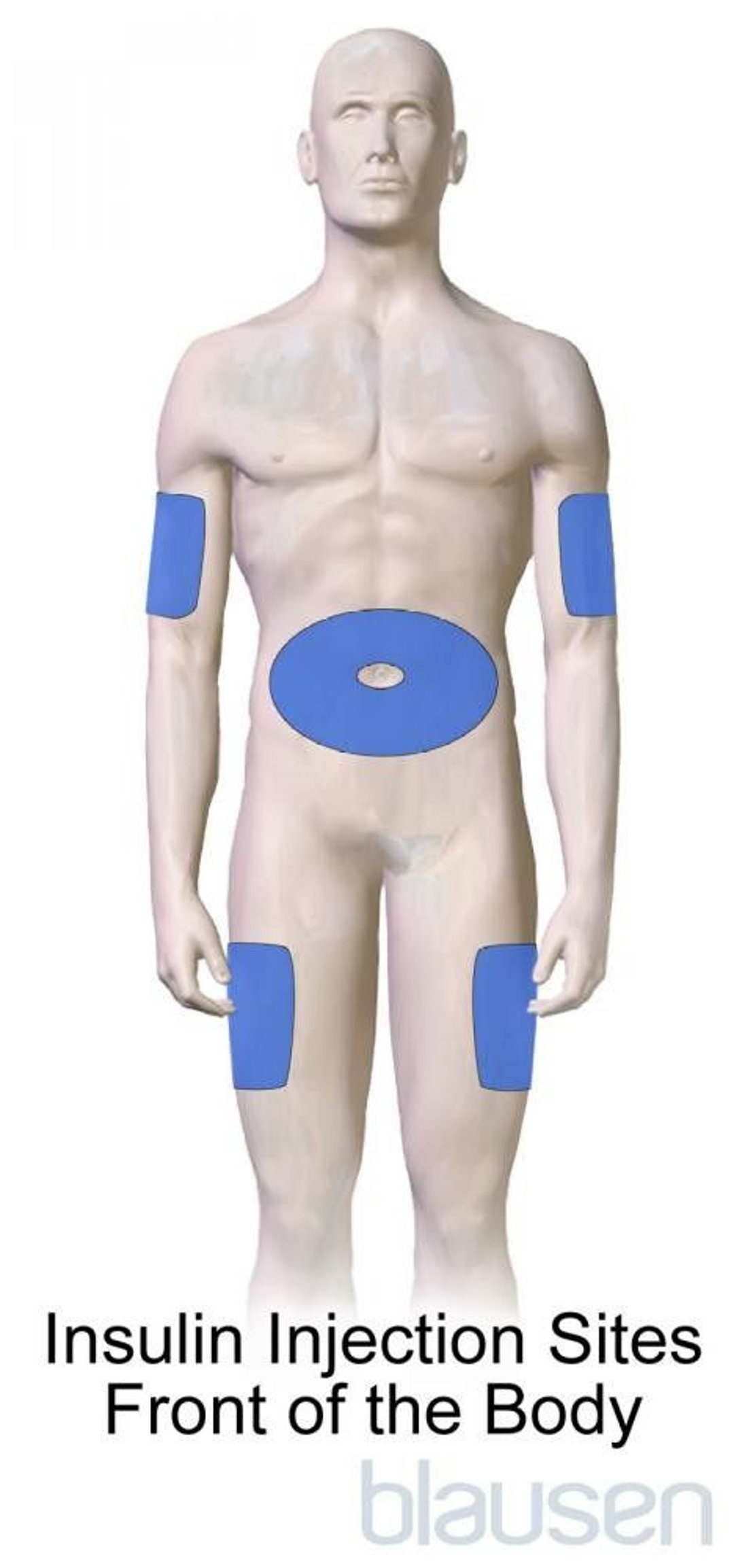 Diabetes Insulin Injection Sites (Front of the Body)