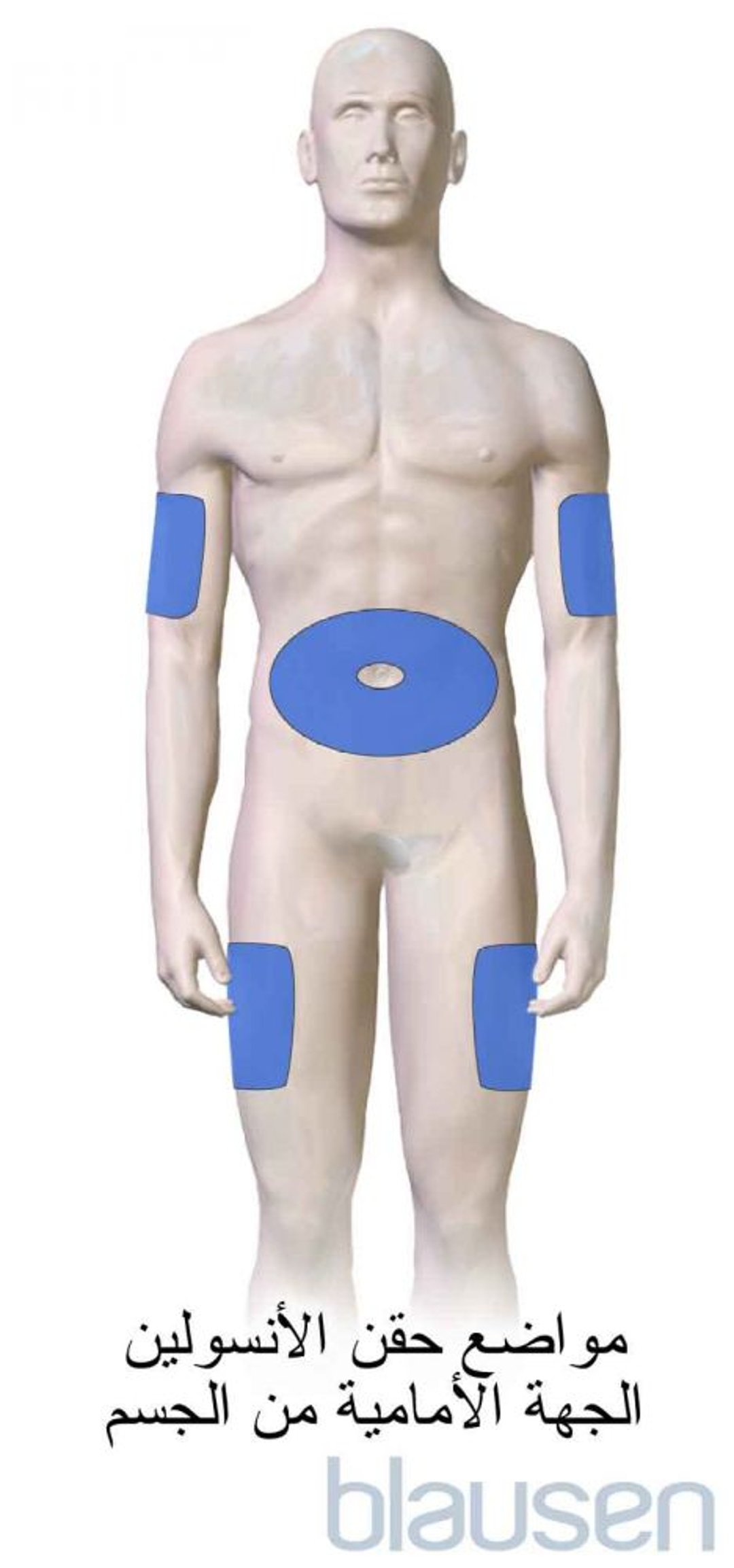 مواقع حقن الأنسولين لعلاج السكري (الجزء الأمامي من الجسم)