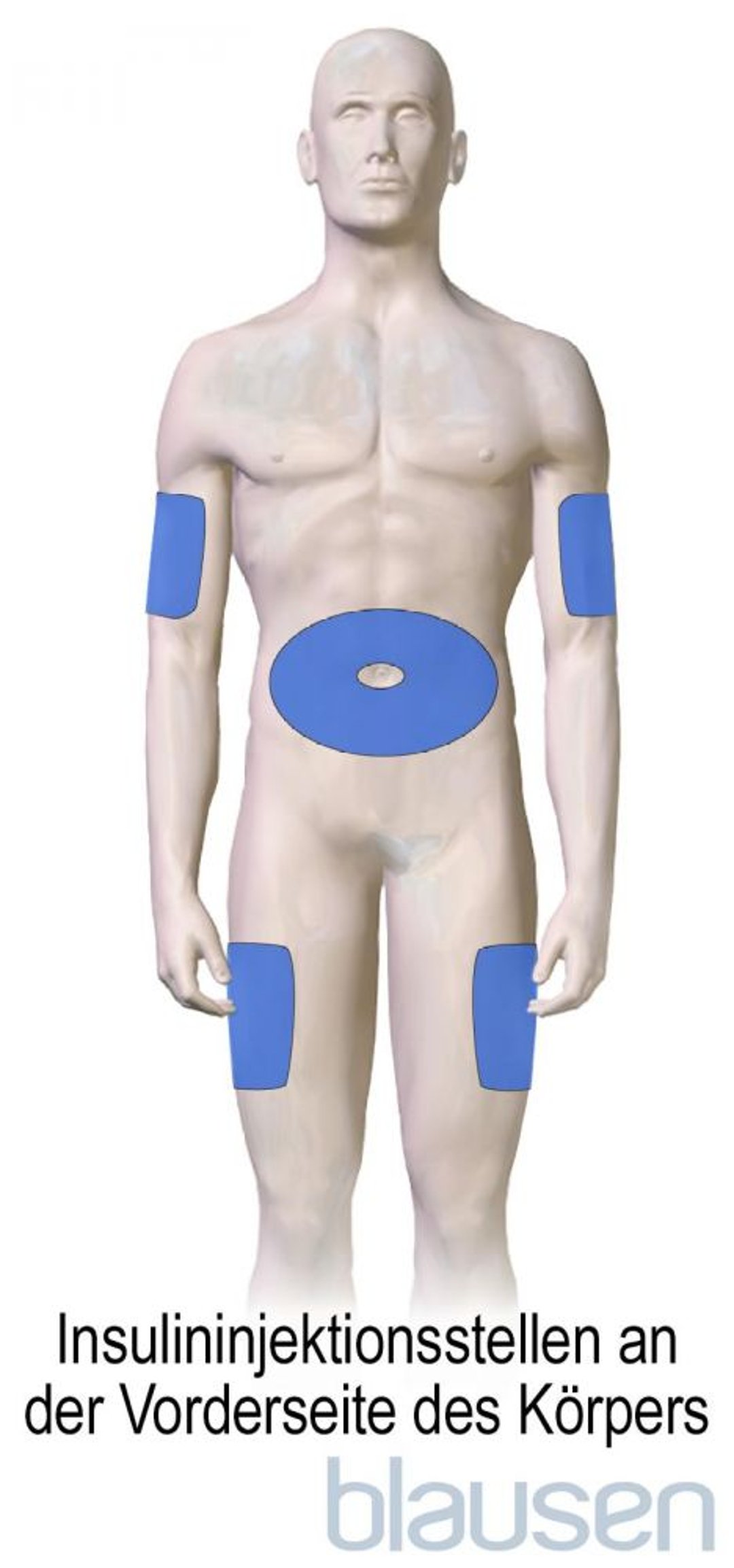 Insulininjektionsstellen bei Diabetes (Vorderseite des Körpers)