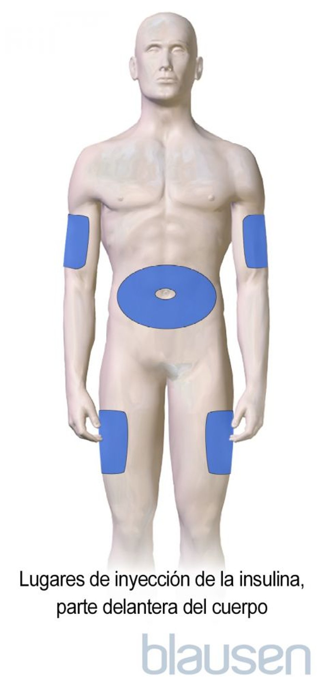 Lugares de inyección de insulina para la diabetes (parte frontal del cuerpo)