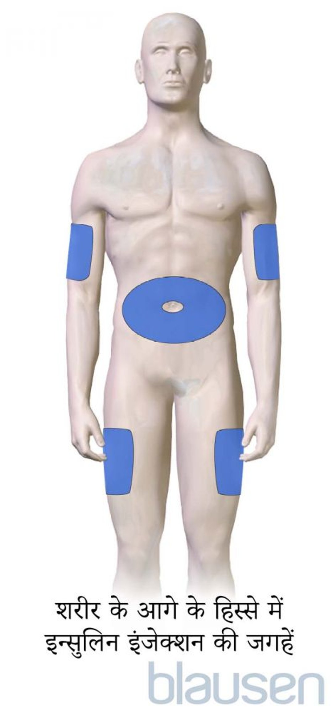 डायबिटीज के इंजेक्शन लगाने की जगहें (शरीर के आगे के हिस्से में)