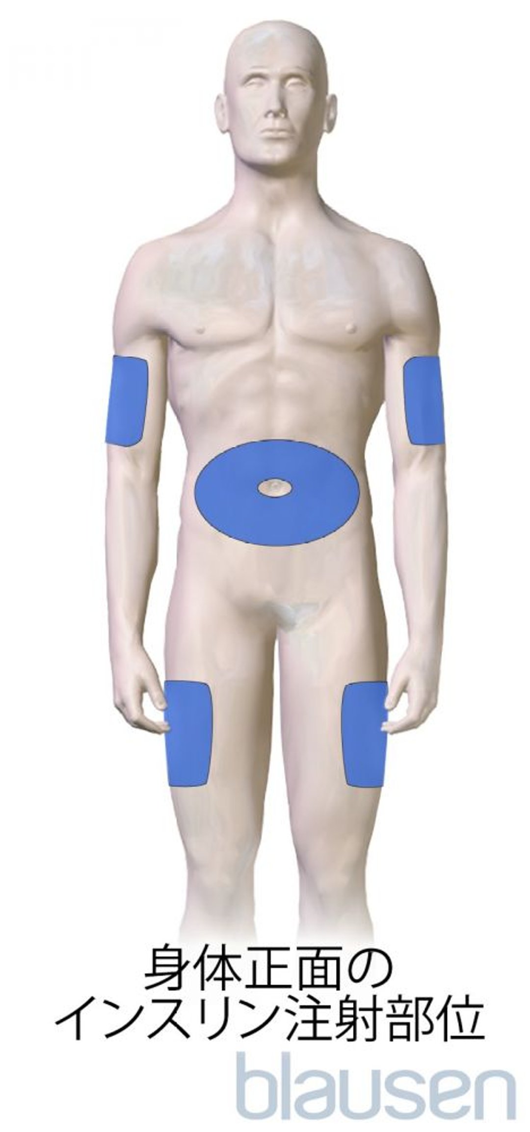 糖尿病のインスリン注射部位（体の前面）