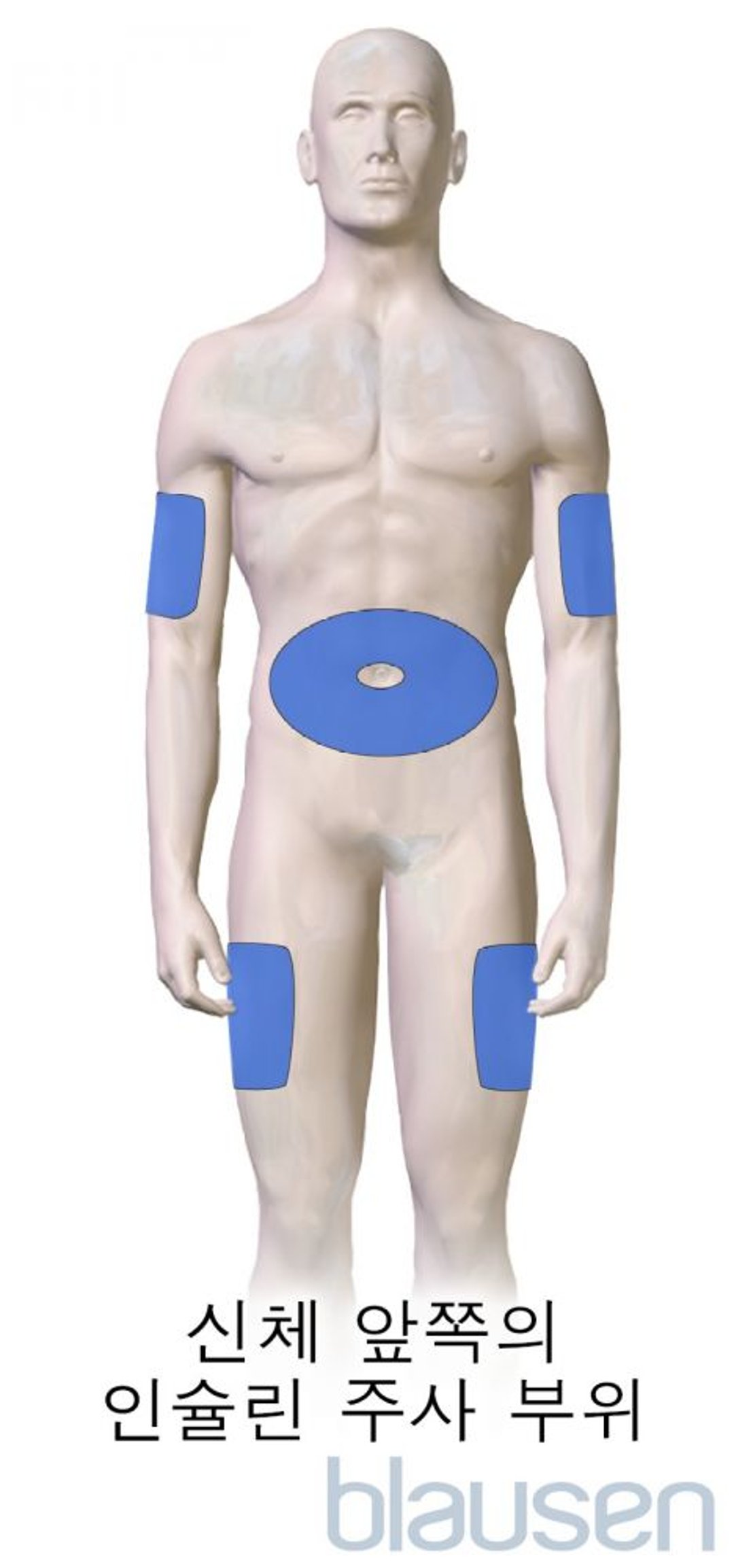 당뇨병 인슐린 주사 부위(신체 앞쪽)