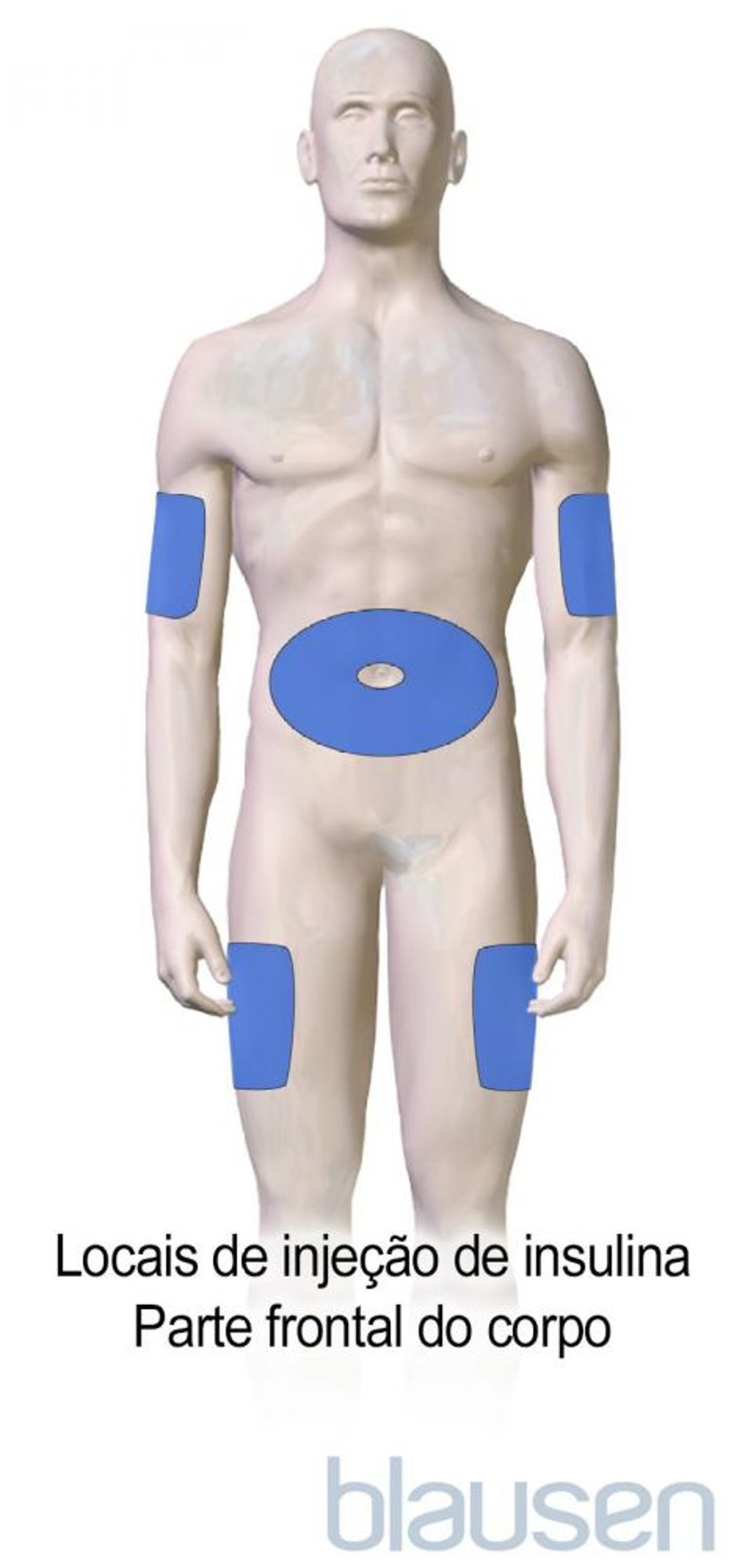 Locais de injeção de insulina para diabetes (parte frontal do corpo)