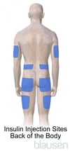 Diabetes Insulin Injection Sites (Back of the Body)