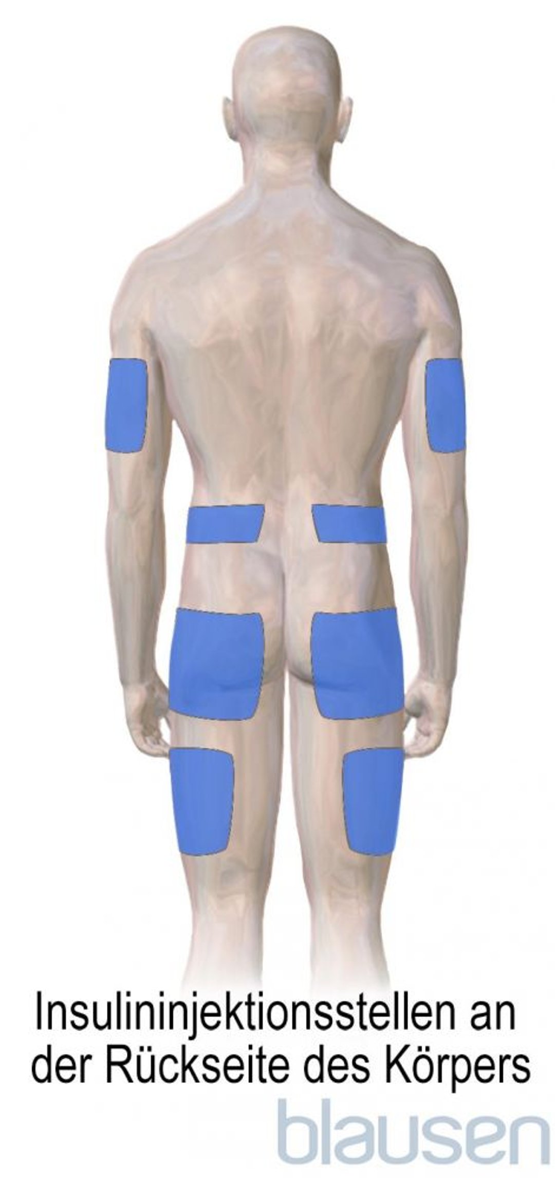 Insulininjektionsstellen bei Diabetes (Rückseite des Körpers)