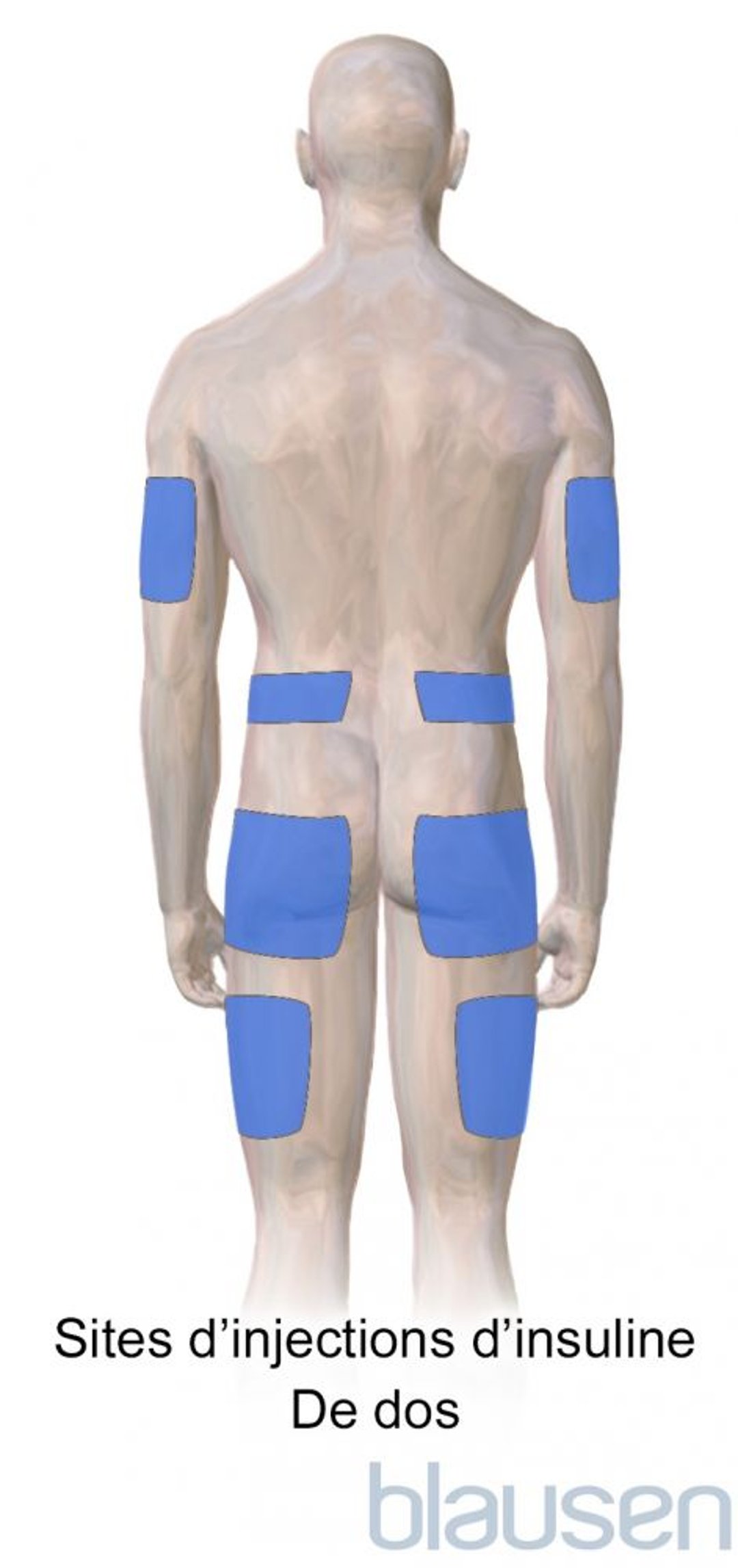 Sites d’injection de l’insuline dans le cadre du diabète (arrière du corps)