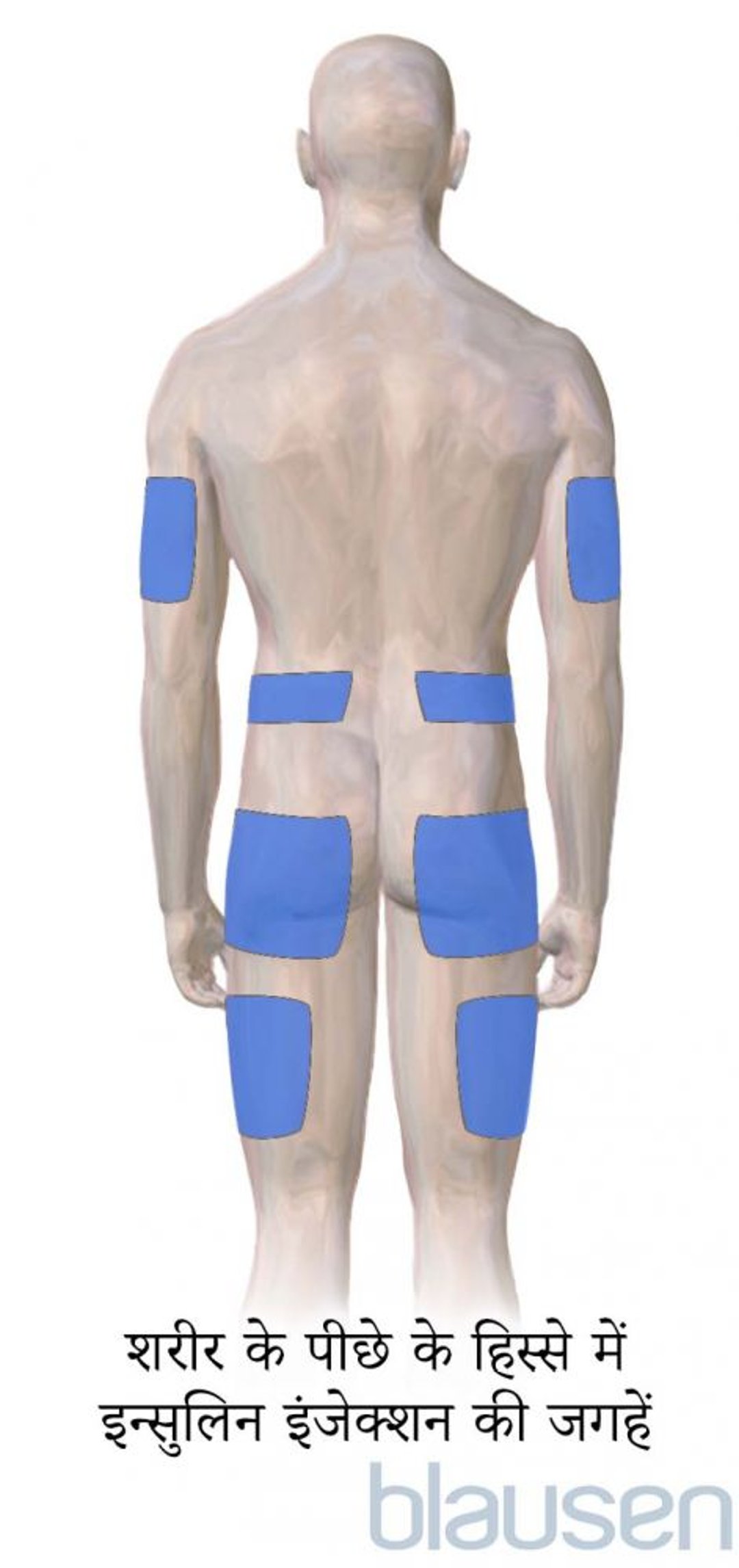 डायबिटीज के इंजेक्शन लगाने की जगहें (शरीर के पीछे के हिस्से में)