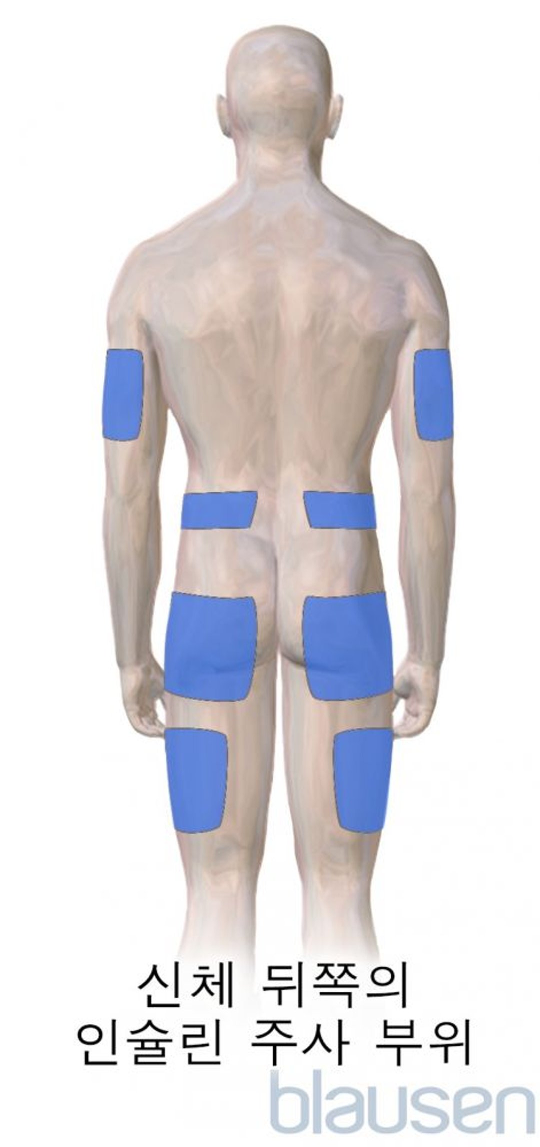 당뇨병 인슐린 주사 부위(신체 뒤쪽)