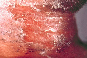Diphtherie mit Befall der Haut