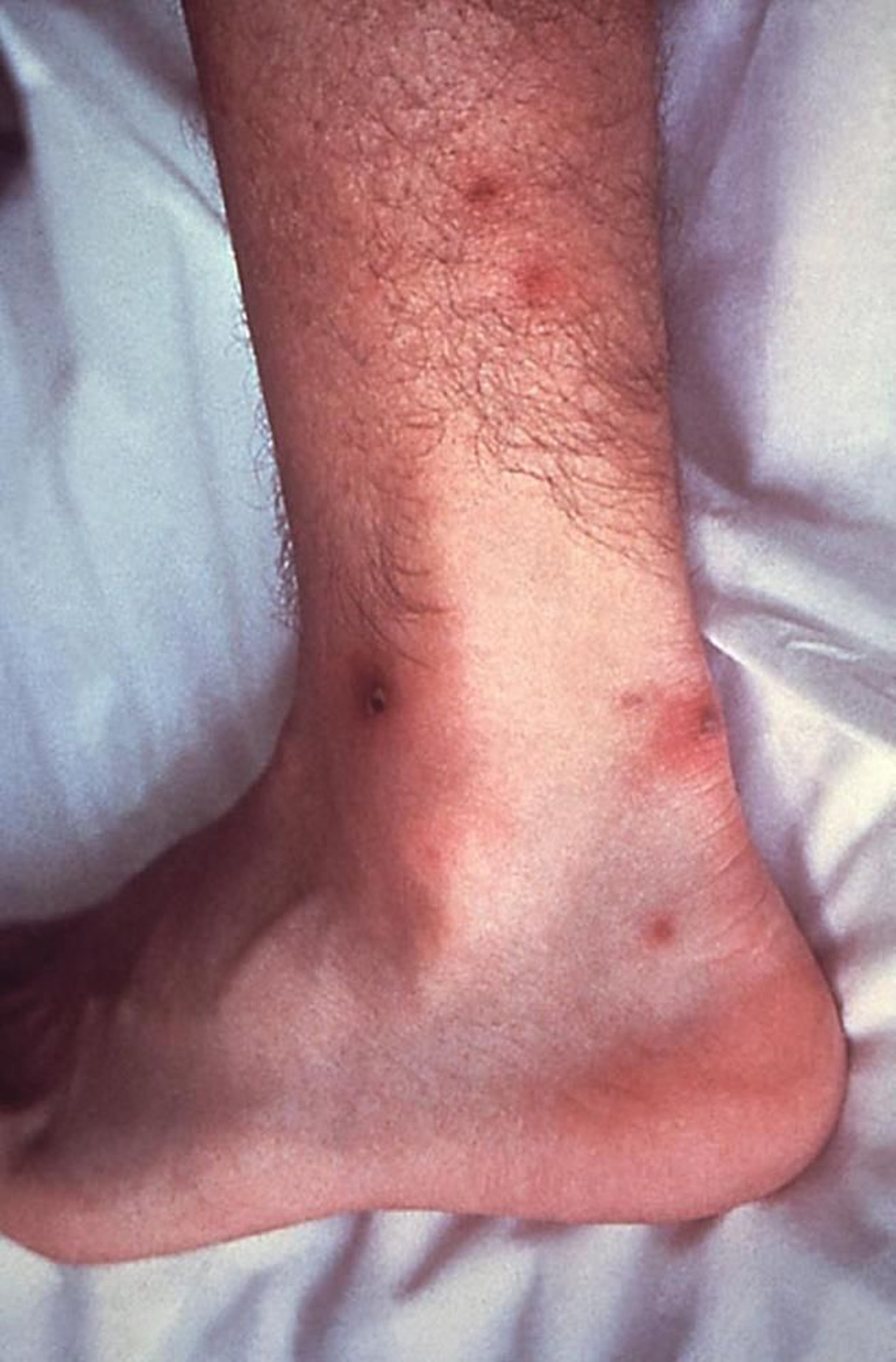 Disseminierte Gonokokkeninfektion mit Befall der Haut