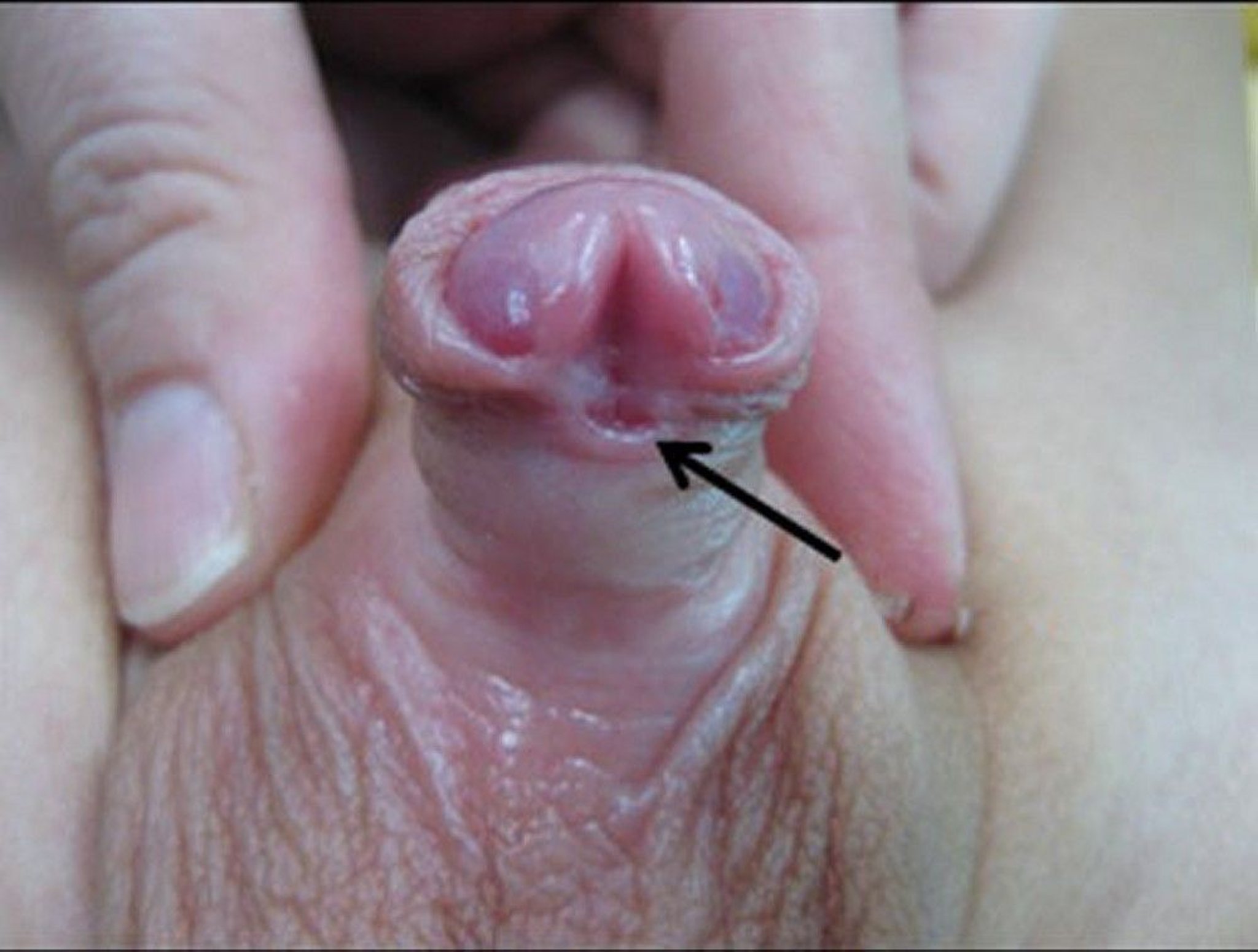 Mild Hypospadias