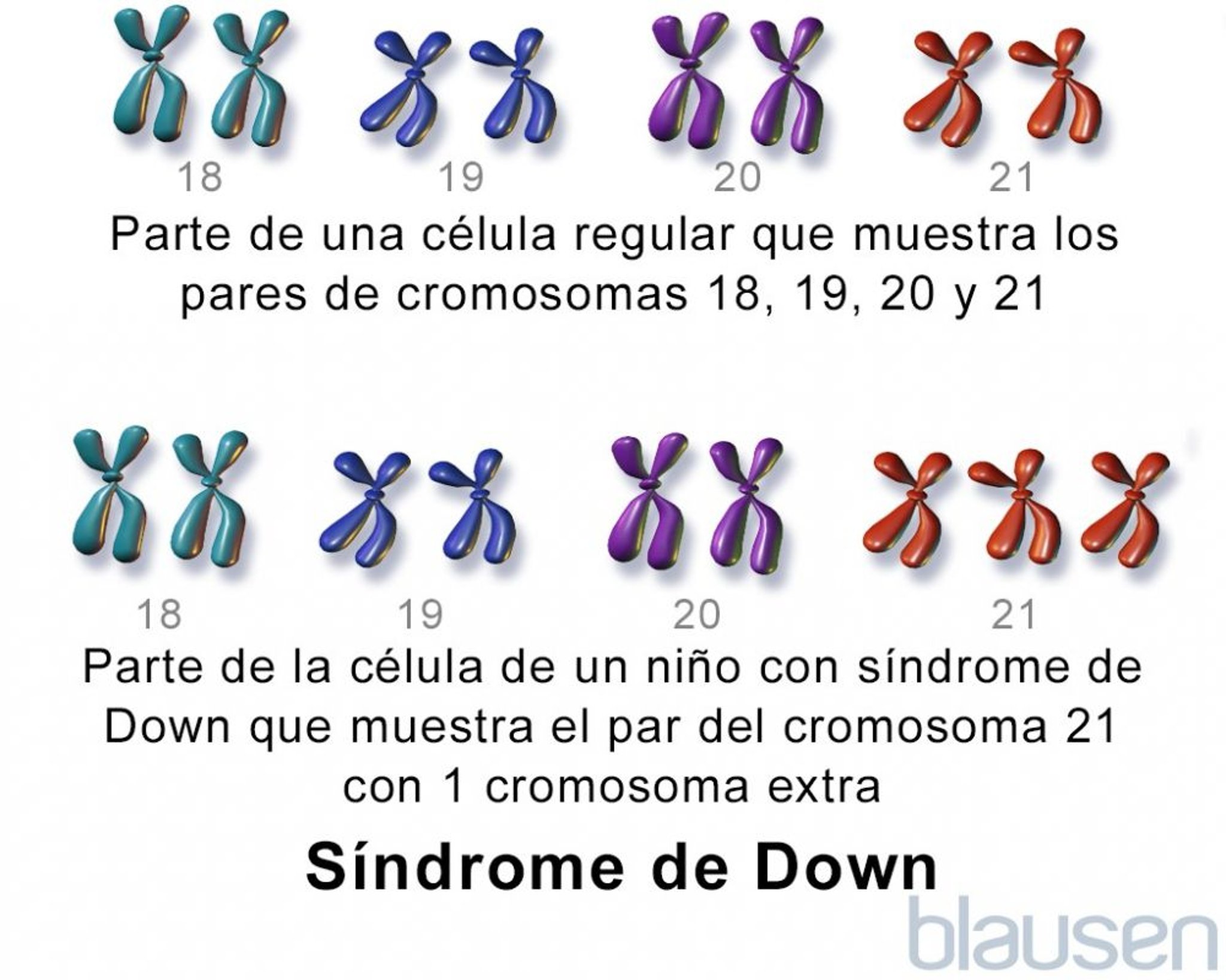 Síndrome de Down; trisomía 21